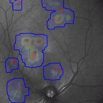 Floater Tracking gif